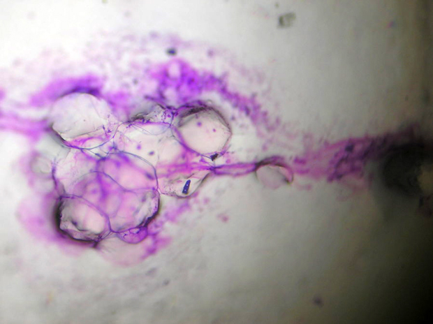 脂肪腫の顕微鏡写真